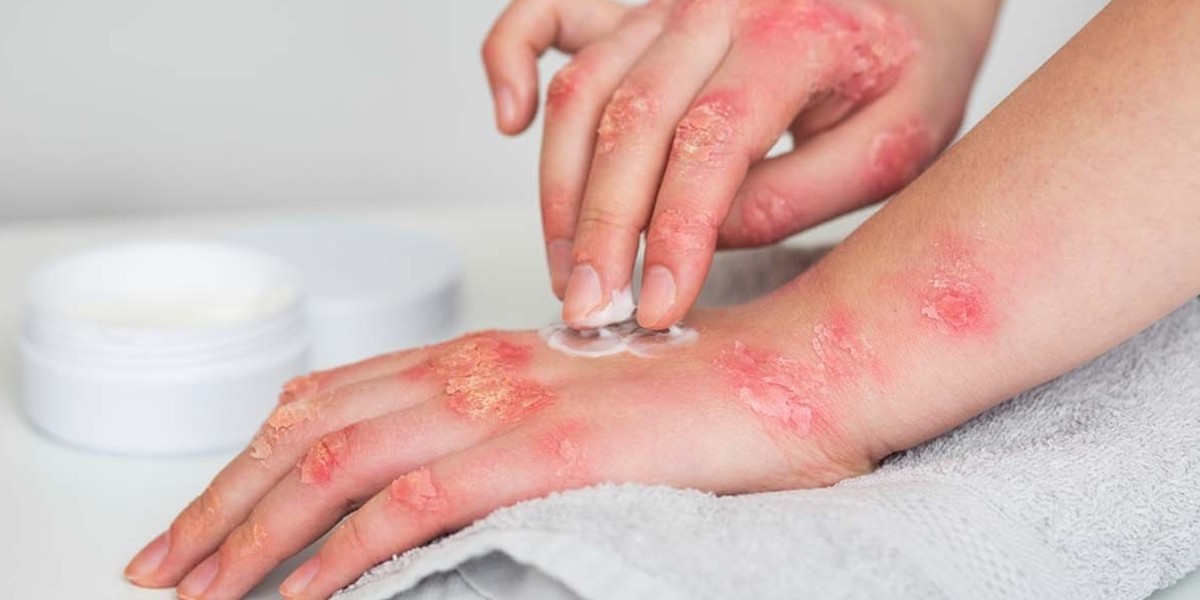 uyuz olmamak için ne yapmak gerekiyor