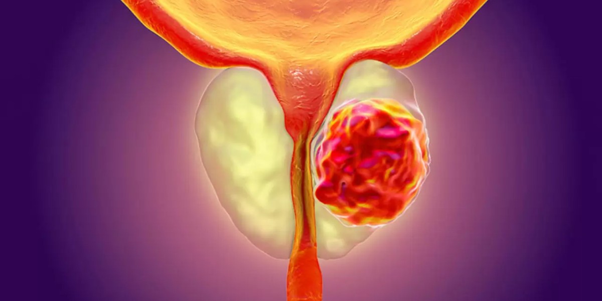 Prostat Kanseri Uyarısı: 40 Yaş Üstü Erkekler