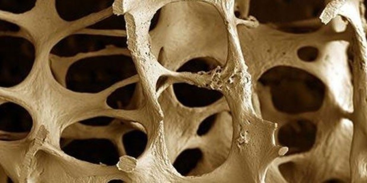 OSTEOPOROZ NEDİR